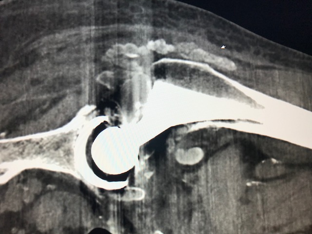 Figure 6 for case Tumoral calcinosis ( RID5202 )